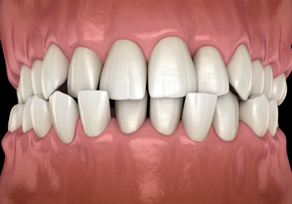 Schiefe Zähne, falsches Schlucken, Artikulationsstörung – Was können wir tun?