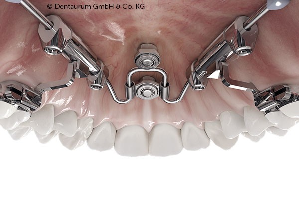 Minischrauben in der Kieferorthopädie